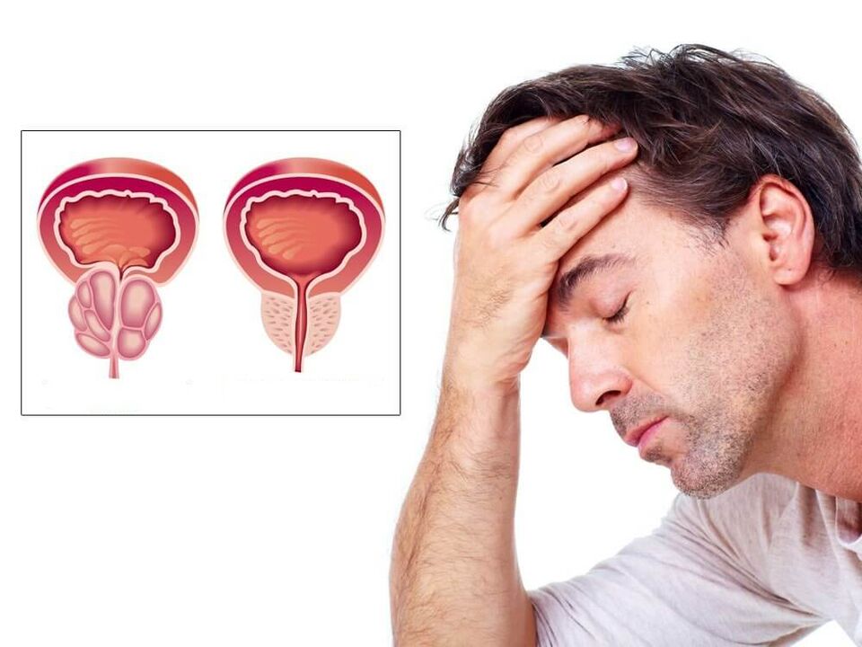 simptome de prostatita la barbati
