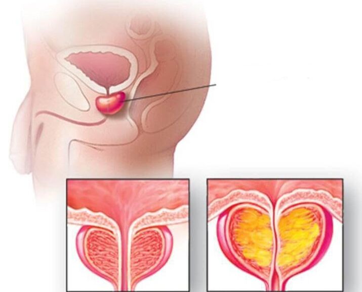 Localizarea glandei prostatei, prostată normală și mărită în prostatita cronică