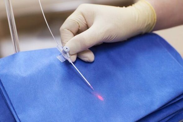 În unele cazuri, terapia cu laser este utilizată pentru prostatita cronică