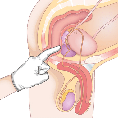 Determinarea stării prostatei prin palpare pentru diagnosticul de prostatită