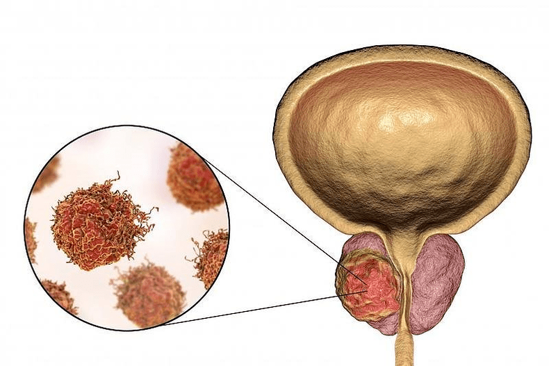 cum arată afectarea prostatei
