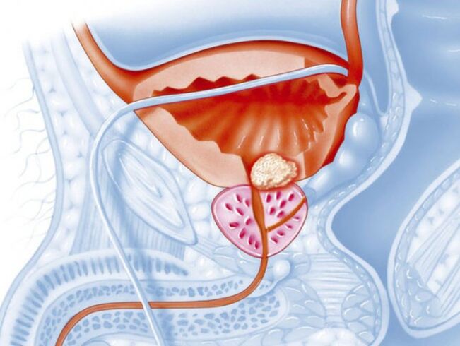 Prostatita bacteriana