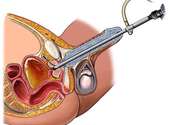 Tratamentul prostatitei