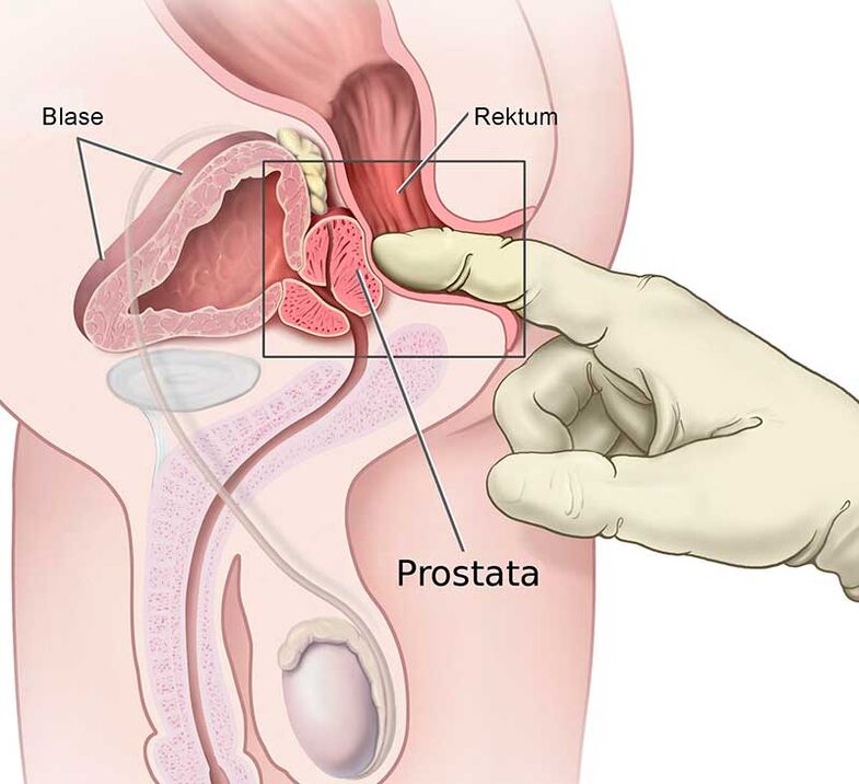 masaj de prostată pentru prostatită