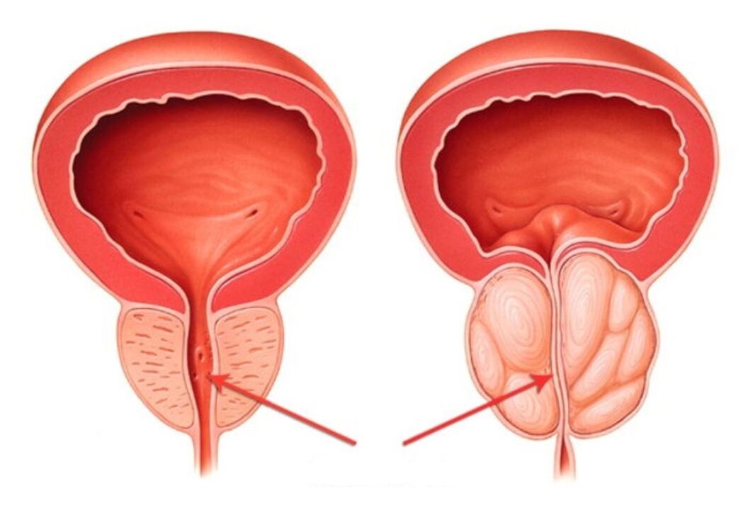 prostată sănătoasă și inflamată cu prostatita