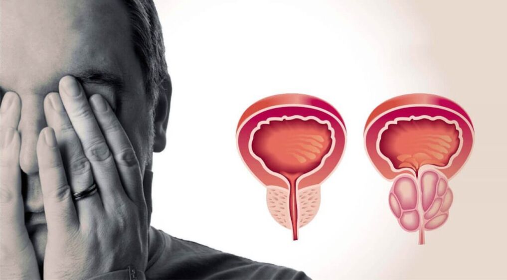 Prostată sănătoasă și inflamată